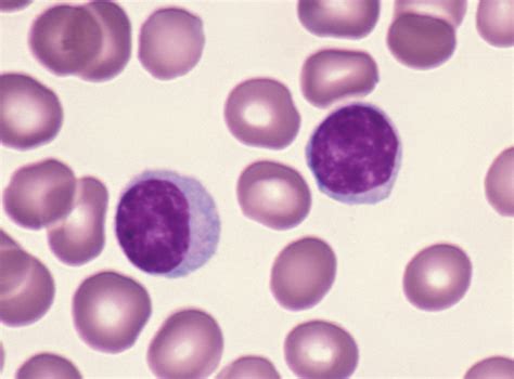 How To Identify Lymphocytes In A Blood Smear Pathology Student