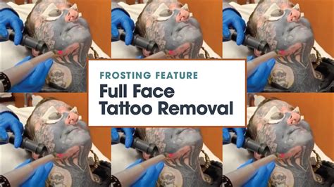 Frosting Feature Full Face Tattoo Removal Removery Youtube