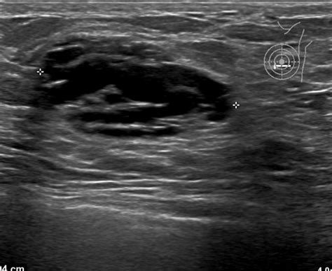 Breast Lactational Adenoma Image