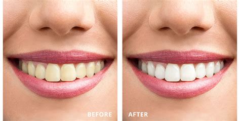 Teeth Whitening Highfield Dental