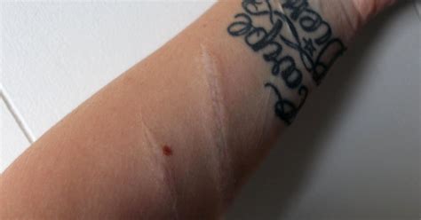 Woman Posts Scars From Suicide Attempt To Help Troubled Teens