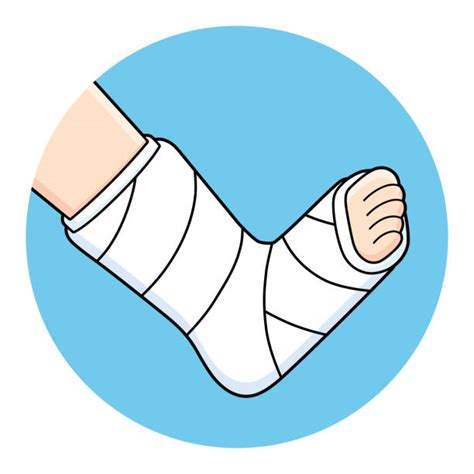 Broken Leg Illustrations Royalty Free Vector Graphics And Clip Art Istock