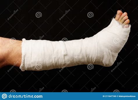 Plaster Cast On The Leg On A Black Background Stock Photo Image Of