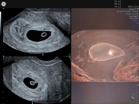 The Value Of Transvaginal Ultrasound During Pregnancy Empowered Women