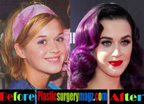 Katy Perry Plastic Surgery Before And After Plastic Surgery Magazine