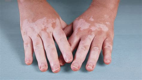 Vitiligo Causas Sintomas E Tratamento Mdsaúde