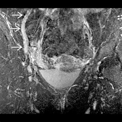 Femoral Neuropathy Radiology Key