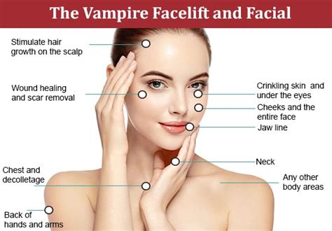 Vampire Lift Treatment Vernon Skin And Hair Clinic