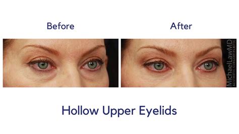 dr michael law discusses how to treat hollow upper eyelids youtube