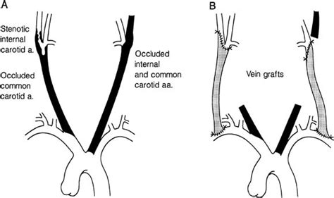 Extrathoracic Carotid Reconstruction The Subclavian Carotid Artery