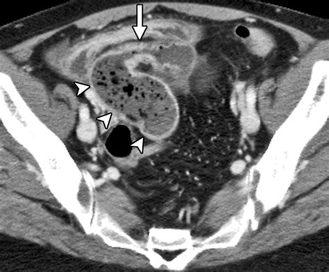 Small Bowel Crohn Disease At Ct And Mr Enterography Imaging Atlas And
