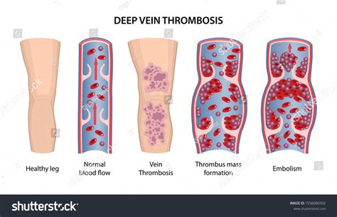 Deep Vein Thrombosis Image Healthy Diseased Stock Vector Royalty Free