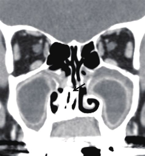 The Axial A And Coronal B Paranasal Sinus Computed Tomography Scans