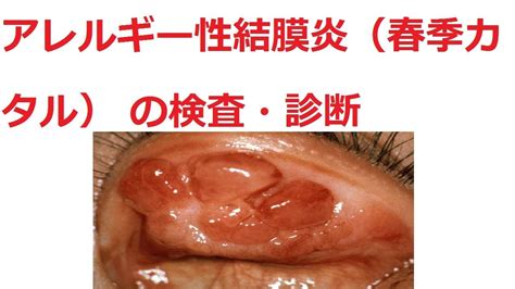 アレルギー性結膜炎（春季カタル） の検査・診断 - YouTube