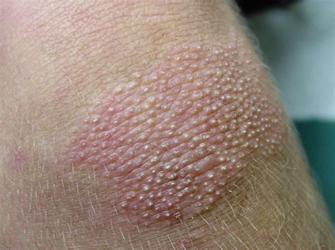 How To Cure Chicken Skin Keratosis Pilaris