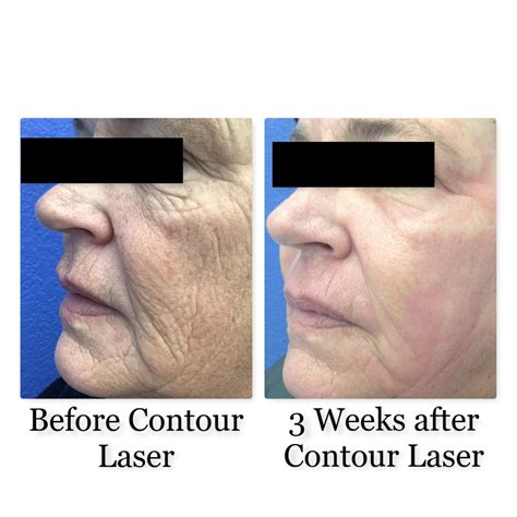 Contour Laser Facial Resurfacing Bismarck Nd Pure Skin Aesthetic