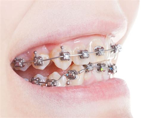 Best Braces For Overbite Orthodontist Approved