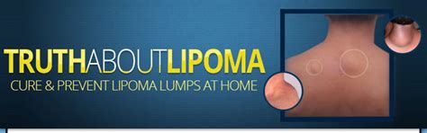 How To Remove Lipoma Naturally Treatment Hemangioma