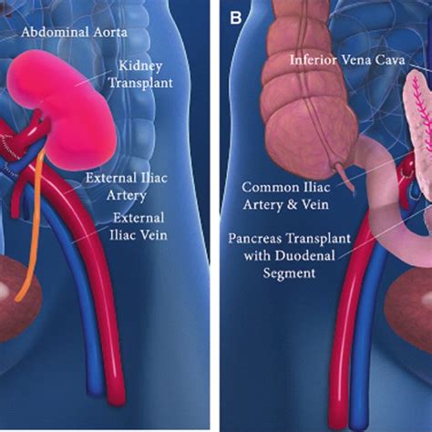 5 Schematic Representation Of Pancreas Kidney Transplantation A