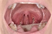 Streptococcal tonsillitis - Stock Image - C047/2809 - Science Photo Library