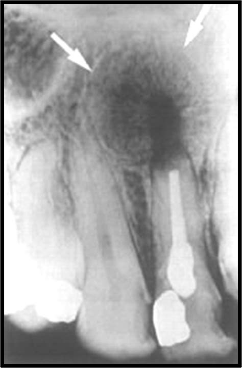 Radiographic Appearance Of Cysts Part 1 Intelligent Dental