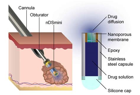 Implantable Drug Delivery Device Fights Cancer While Maintaining