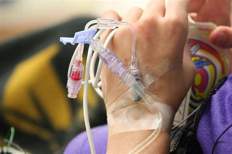 Different Ways To Receive Iv Chemotherapy Access Types