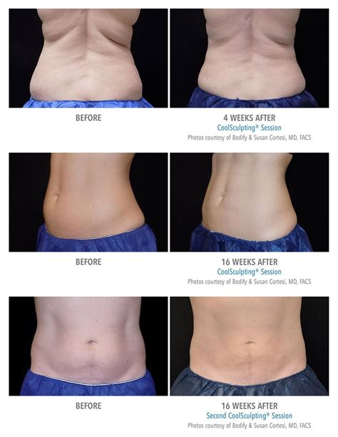 When Do You See Results From Coolsculpting Resutlop