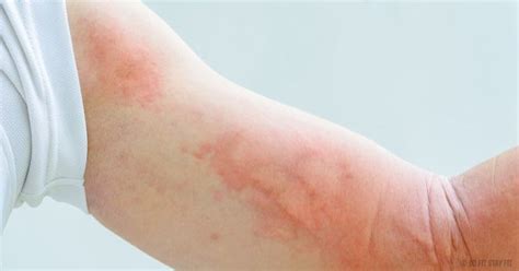 Hives Also Known As Urticaria Nettle Rash And Welts Are A Skin