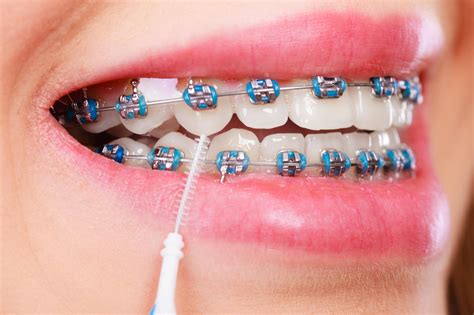 confira   etapas  tratamento  aparelho ortodontico