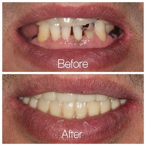 Before And After Successful Full Mouth Implants Restoration Dental Implants Chantilly Fairfax