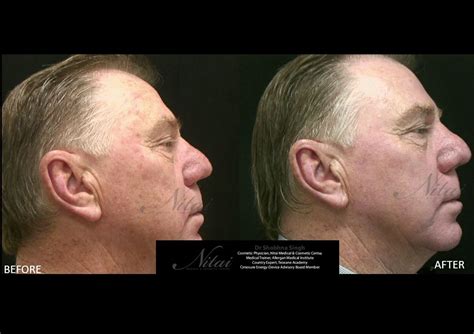 Acne Scarring Treatments Melbourne Archives Laser Skin Treatment