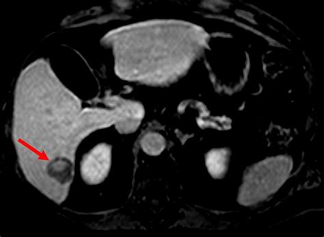 Imaging Example Of A Liver Observation With An Inner Nodule Showing