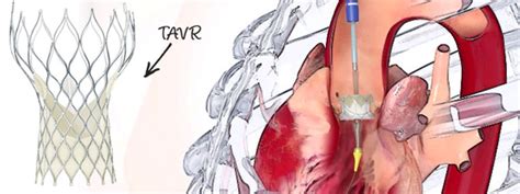 Tavr Faqs Answered By A Cardiologist