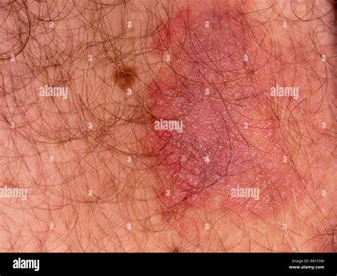 Fungal Infections Stock Photos And Fungal Infections Stock Images Alamy