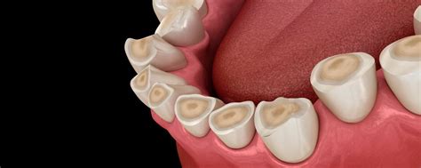 Diagnóstico Tipos Causas Y Tratamientos Para La Erosión Dental