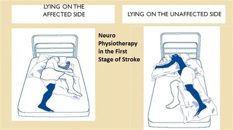 Neuro Physiotherapy In The First Stage Of Stroke By Dr Vishwas