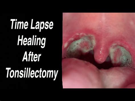 Tonsillectomy Time Lapse Healing Day By Day From Day 0 Day 25 Chords
