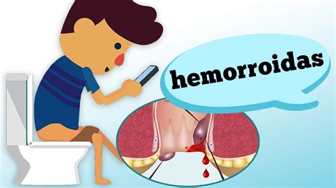Hemorroidas Quais Os Sintomas E Caracter Sticas Youtube