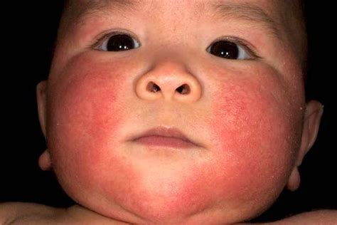 Childhood Atopic Dermatitis A Cross Sectional Study Of Relationships