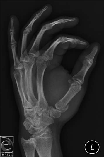 Fracture Of The Base Of The First Metacarpal Bone