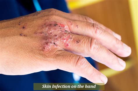 Bacterial Infections On The Skin Kens Health Blog