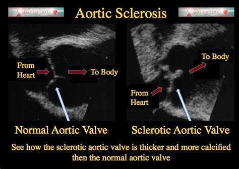 Aortic Sclerosis Is It Dangerous Aortic Valve Cardiac Sonography