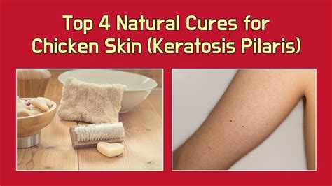 Top 4 Natural Cures For Chicken Skin Keratosis Pilaris Youtube