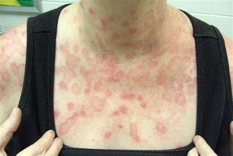 Tinea Rash