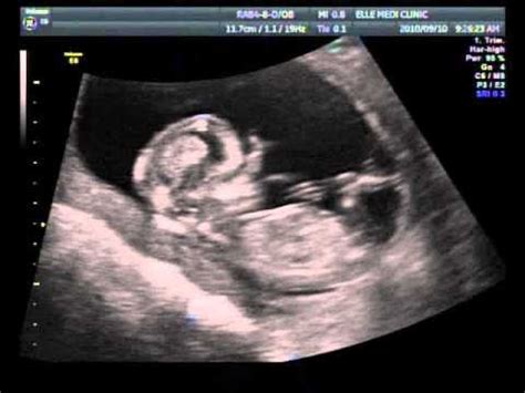 Ultrasound at 12 weeks pregnancy. 3D Ultrasound at 12 Weeks - YouTube
