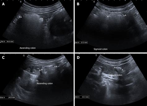 Shows The Ascending Colon And Sigmoid Colon Images Of A Constipated
