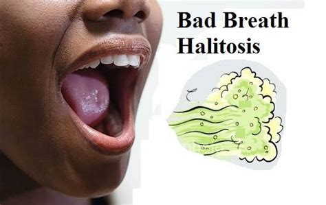 best natural remedy for halitosis bad breath