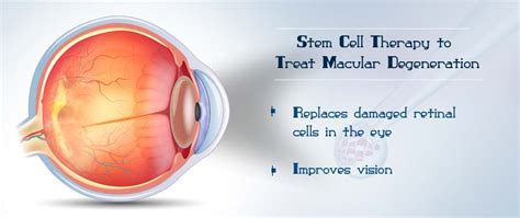 Stem Cell Therapy To Treat Dry Macular Degeneration