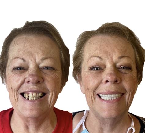 Before After Implant Dentistry Restorative Dentistry Dental Implants
